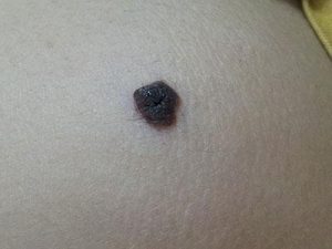 黑色素瘤的死亡率高吗？